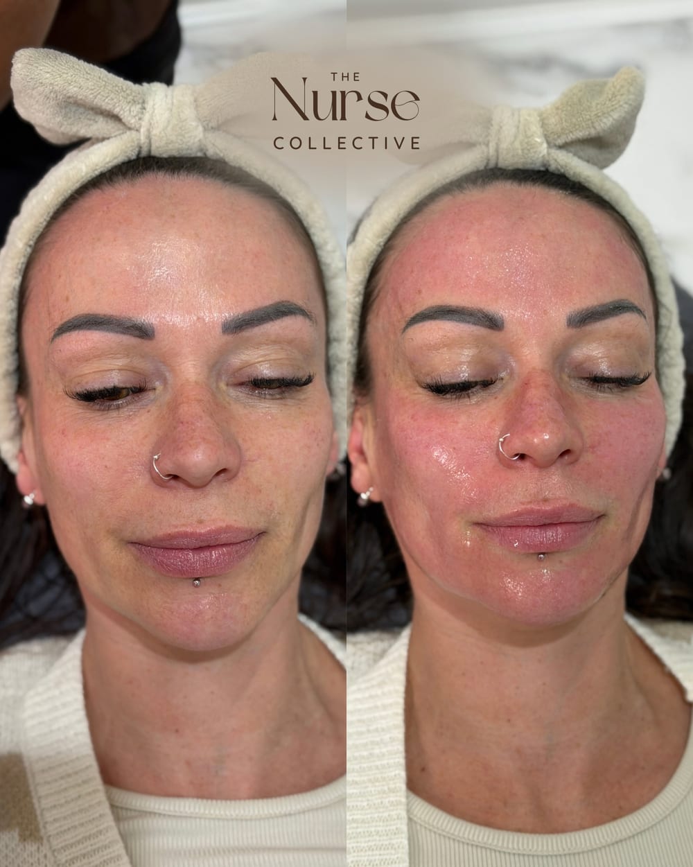 Client skin before treatment and immediately after, showing fresh glowing skin